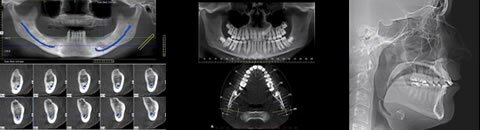 歯科用CT